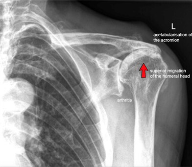 rotator cuff arthropathy